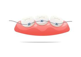 Zähne mit Hosenträger und Zahnfleisch. Dental Gesundheit Konzept. Vektor Illustration.