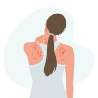 allergisk klåda, hud inflammation, rodnad och irritation. atopisk dermatit, eksem, psoriasis. sjukvård och medicin. vektor