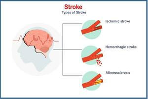 medicinsk vektor illustration i platt stil. begrepp av typer av stroke, ischemisk, hemorragisk och åderförkalkning.