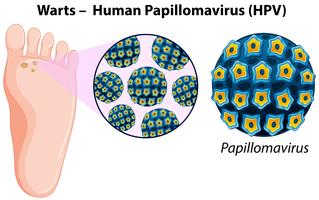 Diagram som visar vårtor i människans fot vektor