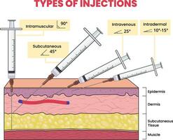 illustration av injektion typer infographic vektor