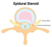 epidural Steroid Wissenschaft Design Vektor Illustration Diagramm