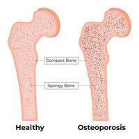 gesund Osteoporose Knochen Wissenschaft Design Vektor Illustration Diagramm