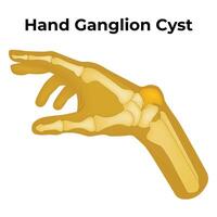 Hand Ganglion Zyste Wissenschaft Design Vektor Illustration Diagramm