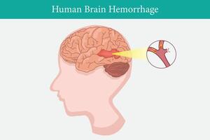 Mensch Anatomie Krankheit hämorrhagisch Schlaganfall Vektor Illustration auf Weiß Hintergrund. eps 10