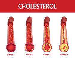 kolesterol i artär, hälsa risk , vektor illustration.
