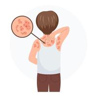 allergisk klåda, hud inflammation, rodnad och irritation. en barn med allergier. sjukvård och medicin. vektor