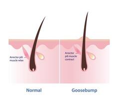 gåshud på de hud vektor illustration isolerat på vit bakgrund. jämförelse av vanligt hud, arektor pili muskel koppla av och gåshud, arektor pili muskel avtal, dra de hår hetero upp.