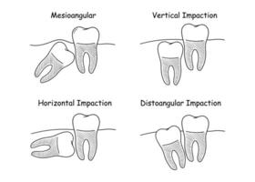 dental anatomi uppsättning, felaktig tänder tillväxt, uppsättning av vektor illustrationer i klotter stil