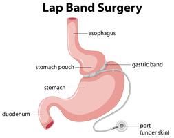 lapband kirurgi diagram vektor