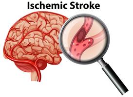 Förstorkt ischemisk strokekoncept vektor