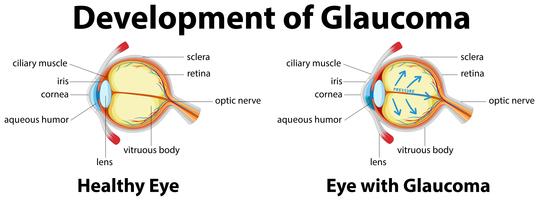 Entwicklung des Glaukoms im menschlichen Auge vektor