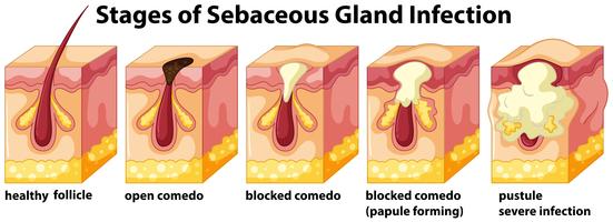 Stages av Sebaceous Gland Infection vektor