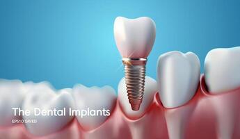 vit tand implantera implantera skära, friska tand eller dental kirurgi. vektor