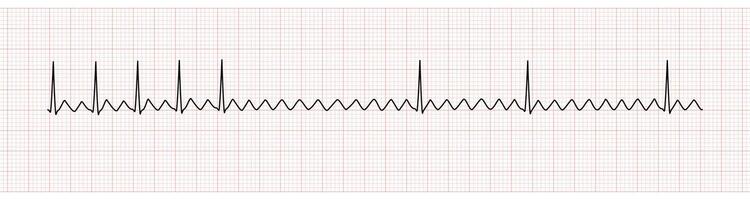 ekg övervaka som visar förmak fladdra med 2 till 1 AV blockera efter adenosin intravenös vektor