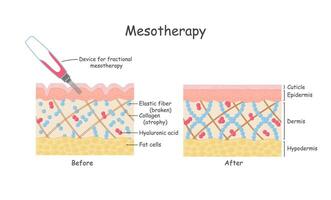 mesoterapi för hud. anatomisk illustration i tecknad serie stil vektor