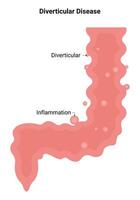 divertikulär sjukdom vetenskap design vektor illustration diagram