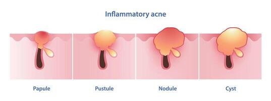 diagram av inflammatorisk acne typer vektor illustration isolerat på vit bakgrund. papule, pustel, liten knöl, nodulär, nodulocystisk, cystisk acne och cysta. hud vård och skönhet begrepp.