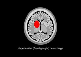basal Ganglien Blutung Gehirn Scan Illustration vektor
