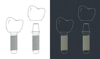 Dental Prothese Blaupausen vektor