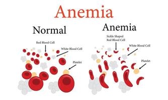 anemi symtom, blod sjukdom. hälsa problem och behandling cell illustration design. vektor