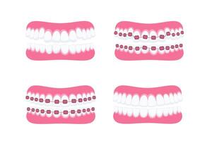 tänder med tandställning. ortodontisk behandling. tand tandställning. tänder med metall konsoler vektor