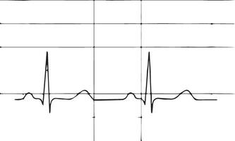 schwarz und Weiß Elektrokardiogramm vektor