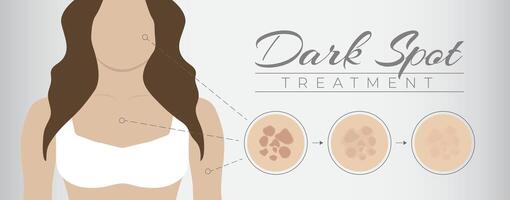 dunkel Stelle Behandlung Illustration Design mit Frau und Melasma Haut Pigmentierung vektor