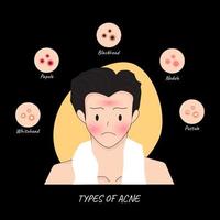 Illustrationen Arten von Akne treten im Gesicht eines Mannes auf vektor
