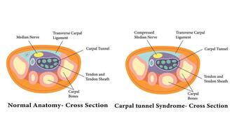 karpal tunnel anatomi diagram illustration design. vektor