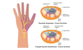 Karpal Tunnel Anatomie Diagramm Illustration Design. vektor