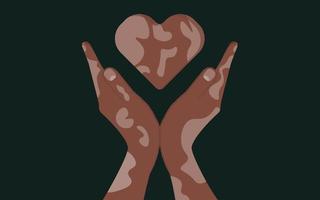 Menschen mit Hautproblemen Vitiligo. Zwei Hände machen eine herzförmige Geste. Körper positives flaches Design der Selbstliebe. Depigmentierungskrankheit. Vektor-Illustration vektor