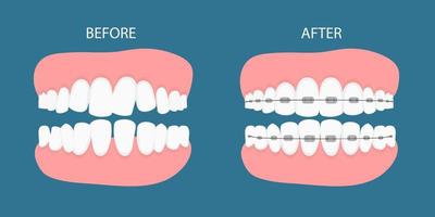 vektor illustration av stadier av ortodontisk behandling hängslen på tänderna. tänder före , efter tandställning på . bakgrund i platt style.vector på blå bakgrund. dental koncept.