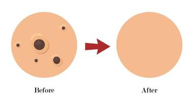 närbild hud, pormaskar finnar akne typ ansikte pore.skincare problem concept.befire efter vektor