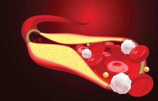 Abbildung der Blockade der roten Blutkörperchen und des Cholesterins vektor
