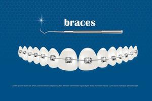 3D-Vektorillustration, realistische Zähne mit Klammern. Ausrichtung des Zahnbisses, Gebiss mit Zahnspange, Zahnspange. vektor