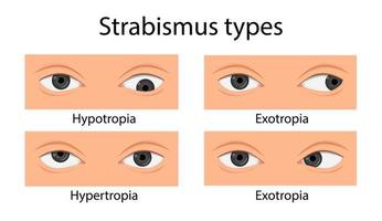 typer av skelning. hypotropi, hypertropi, exotropi, esotropi. tecknad stil vektor