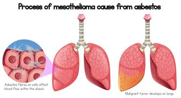 Prozess der Mesotheliom Ursache von Asbest vektor