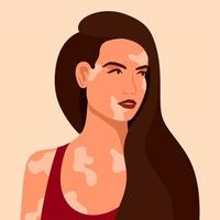 Vitiligo ist eine junge Frau mit Hautproblemen. Hautkrankheiten. das Konzept des Welt-Vitiligo-Tages. verschiedene Hautfarben weiblicher Charaktere. für einen Blog, Artikel, Banner, Magazin. vektor