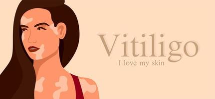 vitiligo är en ung kvinna med hudproblem. hudsjukdomar. begreppet världsvitiligodagen. olika hudfärger på kvinnliga karaktärer. för en blogg, artiklar, banner, tidning. vektor
