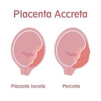 placenta increta och percreta vektor