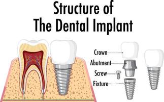 infographic av människa i strukturen av tandimplantatet vektor