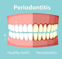 Infografik des Menschen bei Parodontitis