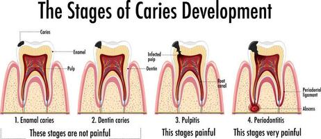 infographic av människan i kariesutvecklingsstadierna vektor