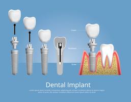 Menschliche Zähne und Zahnimplantat-Vektor-Illustration