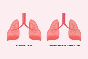 friska lungor och lungor infekterade med tuberkulos vektor