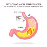 menschlicher Magen. gastroösophageale Refluxkrankheit. Gerd, Sodbrennen, Magen-Infografik. Säure, die in die Speiseröhre aufsteigt. Vektor flaches Design