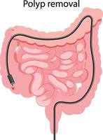 diagram som visar borttagning av polyper vektor