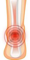 Achillessehnenruptur auf weißem Hintergrund vektor