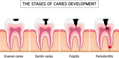 stadier av kariesutveckling vektor